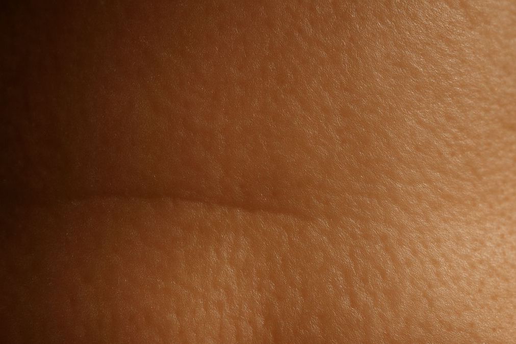 Anti-Wrinkle Injections in London, editorial image